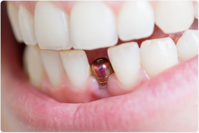 Single tooth implant. Image Credit: Anna Moskvina / Shutterstock